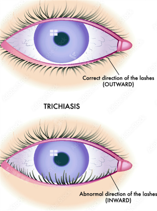 倒睫和正常睫毛生长方向不同