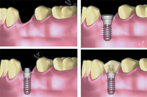 种植牙过程图
