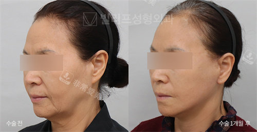 韓國V.LIF比麗普整形外科真人對比側(cè) 韓國V.LIF比麗普整形外科真人對比側(cè)
