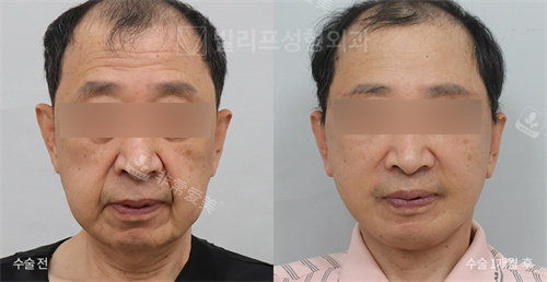 韓國V.LIF比麗普整形外科男士 韓國V.LIF比麗普整形外科男士