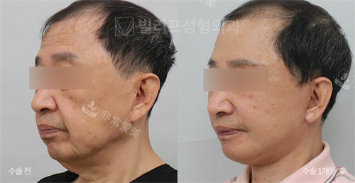 韓國V.LIF比麗普整形外科男士側(cè) 韓國V.LIF比麗普整形外科男士側(cè)