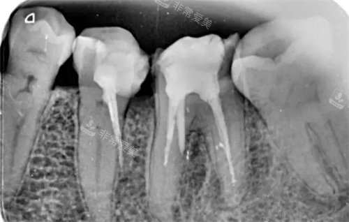 牙齿根管治疗ct照片