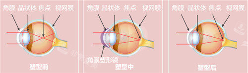 近视矫正手术细节图