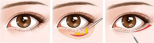 眼袋手术动画示意图