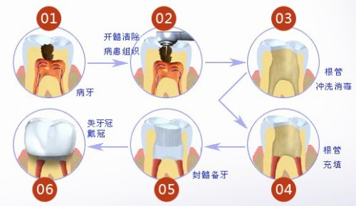 根管治疗示意图