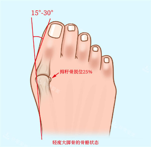 轻度大脚骨图示
