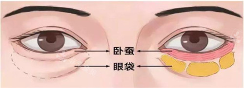 眼袋和卧蚕的位置