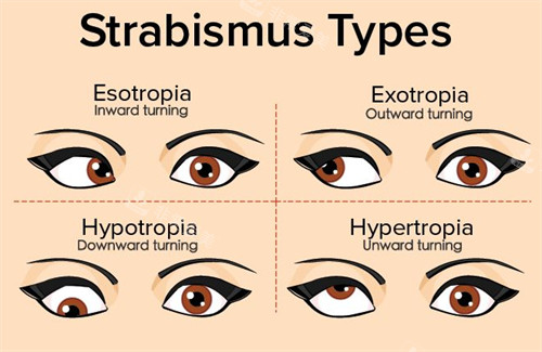 不同症状的斜视