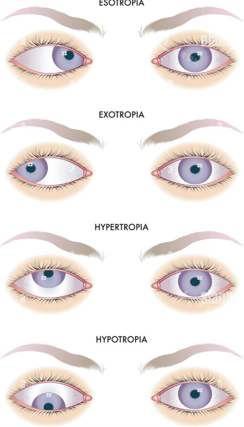 各种类型的斜视