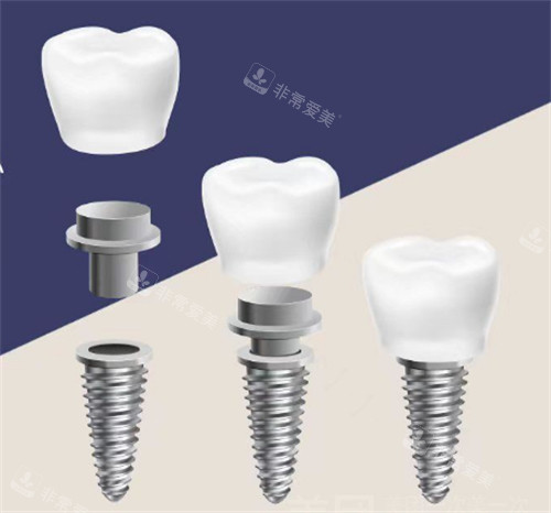 种植牙组成图示
