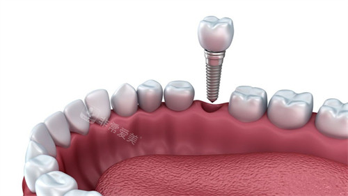 单颗种植牙示意图