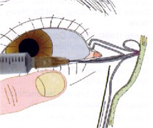 泪道扩张术手术过程图解