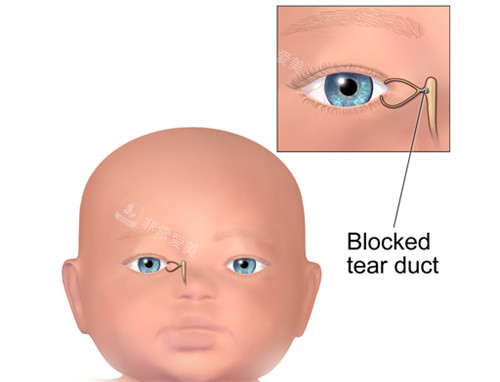 泪道扩张术施术位置图解