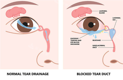 泪囊炎的患病位置图解