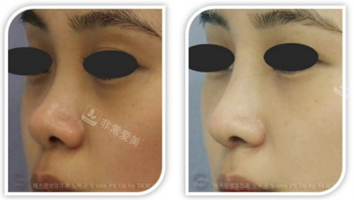 韩国SONE整形外科改善短鼻矮鼻手术前后对比图
