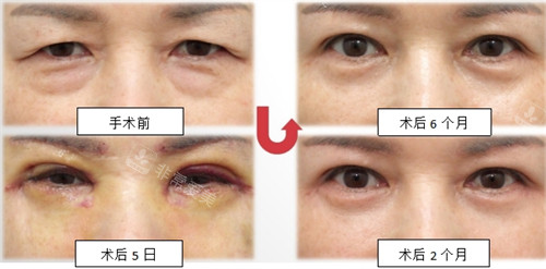 韓國SONE整形外科上下眼瞼整形前后圖示 韓國SONE整形外科上下眼瞼整形前后圖示