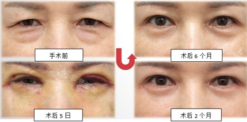 韩国SONE整形外科上下眼睑整形前后图示