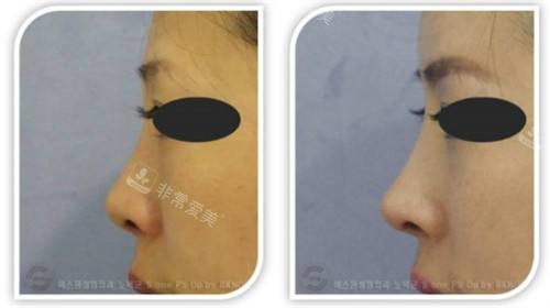 韩国SONE整形外科翘鼻术前后对比图