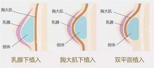 假体隆胸示意图
