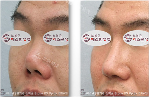 韩国Sone整形短鼻延长手术前后对比图