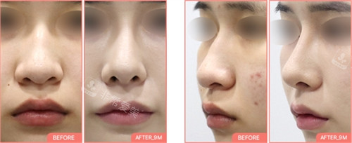 韩国sharp整形隆鼻手术前后对比图