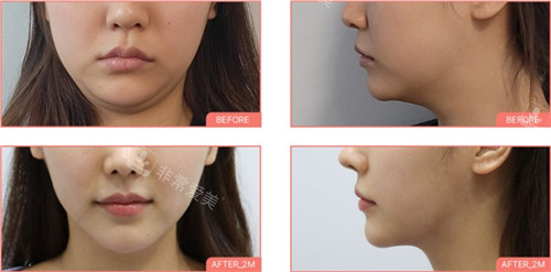 韩国sharp整形面部吸脂手术前后对比图