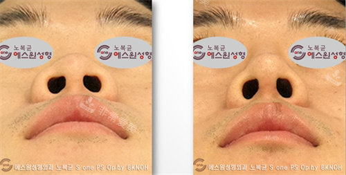 韩国SONE整形男士做鼻子术前术后对比图