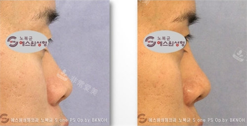 韩国SONE整形男士做鼻子术前术后对比图