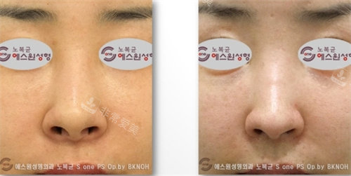 韩国SONE整形鼻修复手术对比图