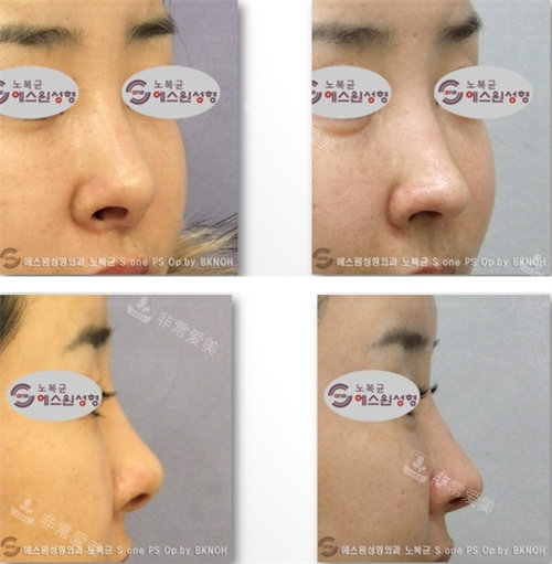 韩国SONE整形鼻修复手术对比图