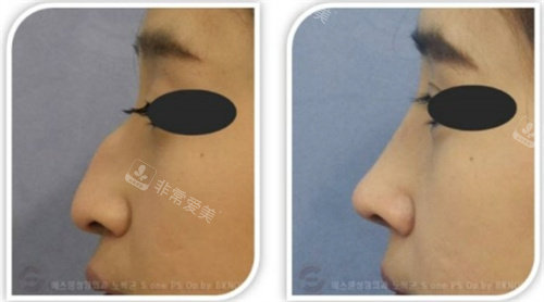 韩国SONE整形外科驼峰鼻矫正对比图