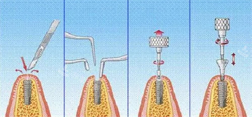 种植牙流程图