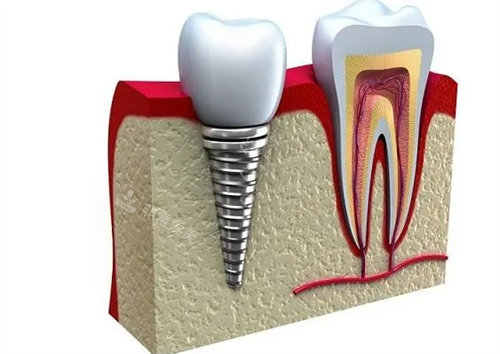 [急]洛阳种植牙多少钱一颗?分享便宜又好的种植牙医院名单!