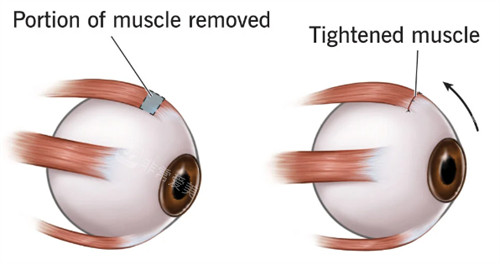 斜视肌腱和正常眼睛的肌腱不同