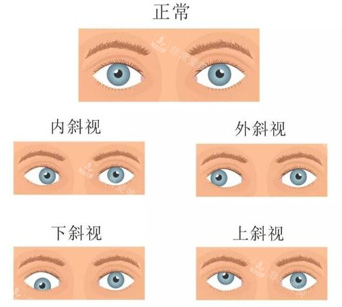 眼睛情况对照图