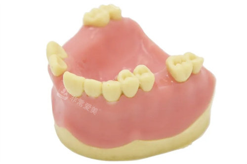 牙齒缺失模型圖