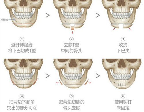 正颌手术