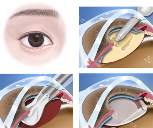 白内障手术过程图解