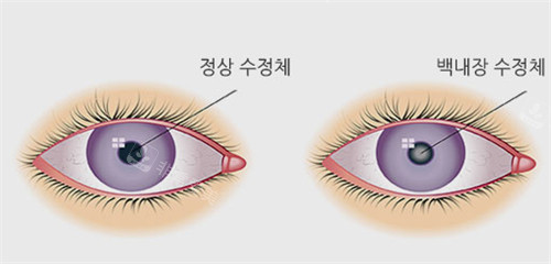 白内障和普通眼睛的区别图解