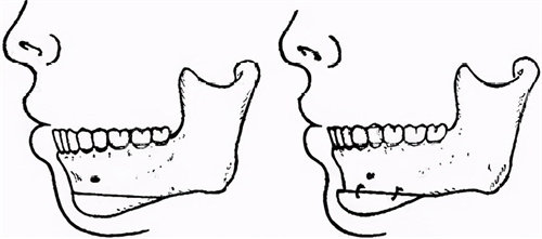 下颏成型术