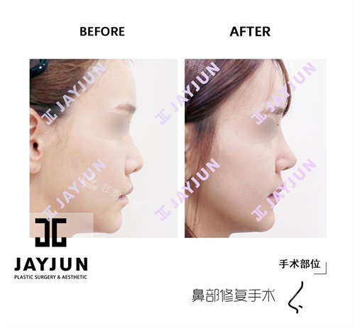 韩国jayjun整形外科鼻修复手术前后对比图