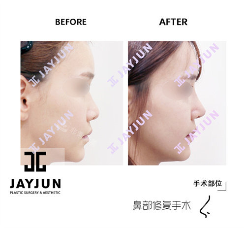 韓國(guó)jayjun整形外科鼻修復(fù)手術(shù)前后對(duì)比圖 韓國(guó)jayjun整形外科鼻修復(fù)手術(shù)前后對(duì)比圖