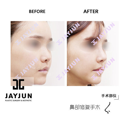 韩国jayjun整形外科鼻修复手术前后对比图侧面