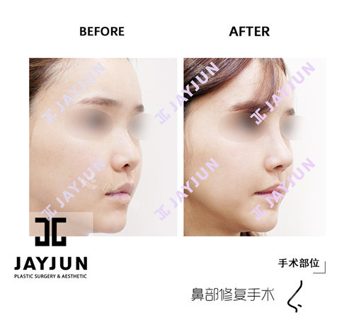 韓國(guó)jayjun整形外科鼻修復(fù)手術(shù)前后對(duì)比圖側(cè)面 韓國(guó)jayjun整形外科鼻修復(fù)手術(shù)前后對(duì)比圖側(cè)面