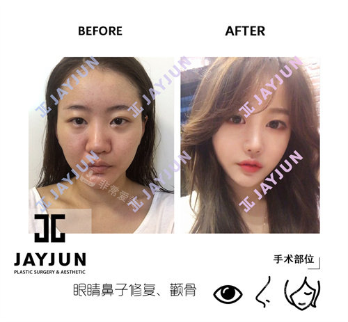 韩国JAYJUN（捷埈）整形外科&皮肤科眼鼻修复颧骨手术前后对比图