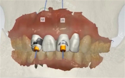 种植牙数字化设计图