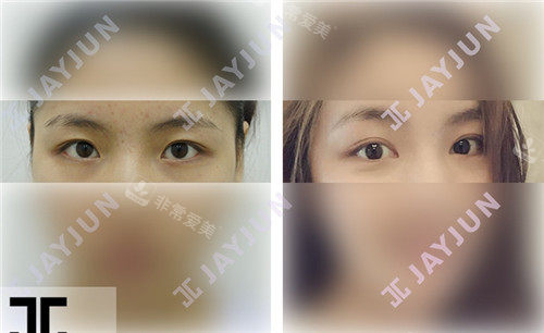 韩国jayjun整形双眼皮手术图