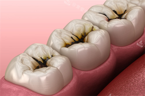 牙齿出现龋坏
