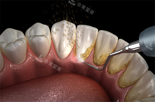 潔牙時(shí)清除牙結(jié)石
