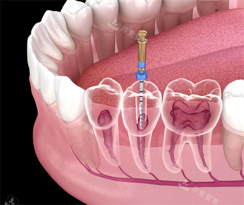 牙齿根管治疗